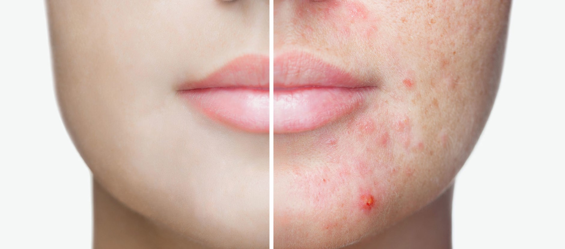 3-does vitamin C help acne-Improve the Appearance of Acne Scars